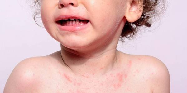 Dinkes Kota Serang Imbau Warga Aktif ke Posyandu Cegah Penyebaran Camp